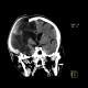 Cerebral ischemia, craniotomy, subarachnoid hemorrhage: CT - Computed tomography